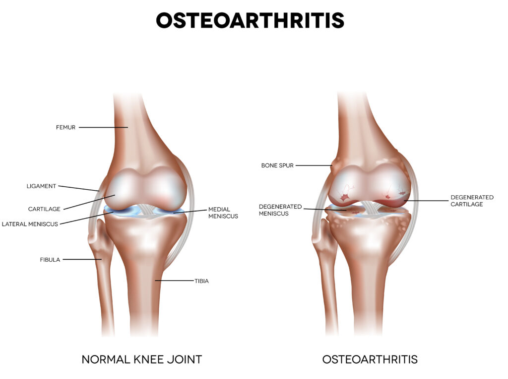 Diagram showing osteoarthritis in knee